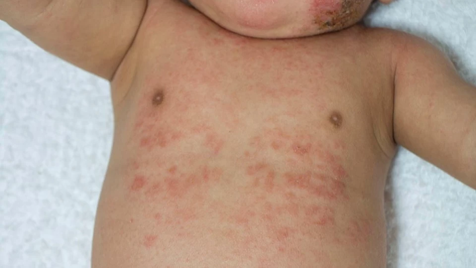 家族皆で挑んだ長男の肌アレルギー克服が原体験